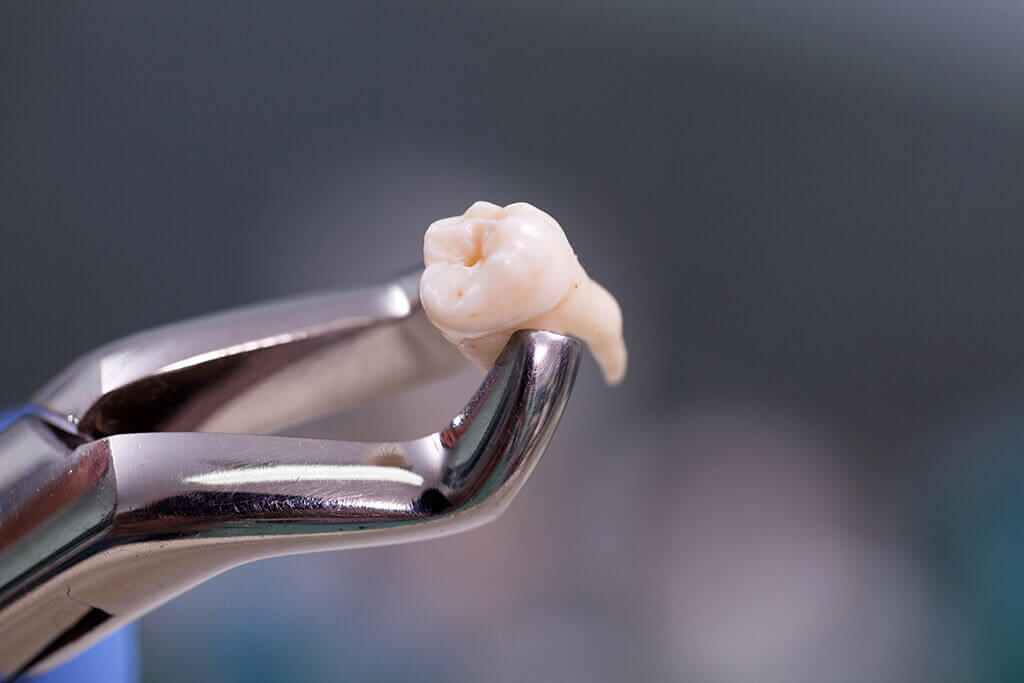 extractii-dentare
